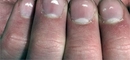 Tırnaktaki Beyaz Lekeler Nasıl Geçer?