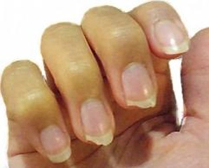 Tırnak Kırılması Belirtileri ve Tedavisi